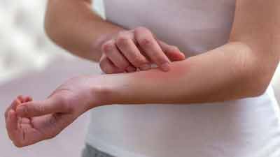 स्किन एलर्जी को ठीक करने के लिए आजमाएं ये घरेलू उपाय